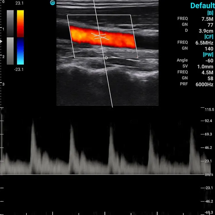 Chison SonoEye P2 Linear Array