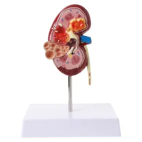 Human kidney disease model Medical prop model Anatomy anatomy disease pathology stone organ teaching supplies