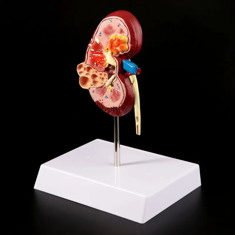 Medical props model Life Size Human Kidney Diseased Model Anatomical Anatomy Diseased Pathological Stone Organ Teaching Supplies