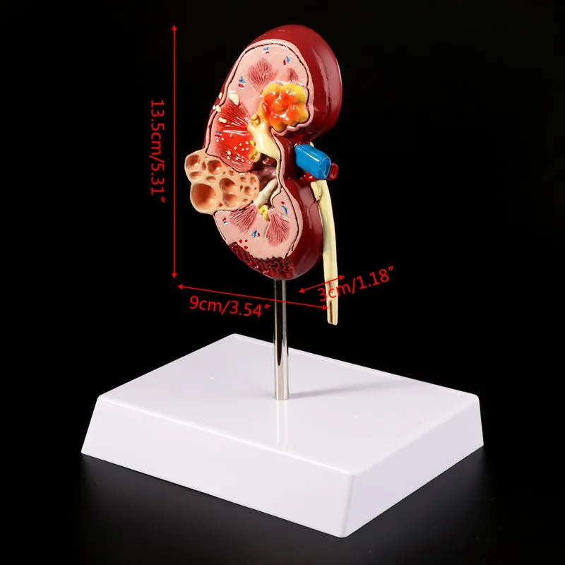 Medical props model Life Size Human Kidney Diseased Model Anatomical Anatomy Diseased Pathological Stone Organ Teaching Supplies